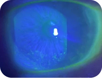 A dry eye patient with the history of autoimmune disease clinical findings