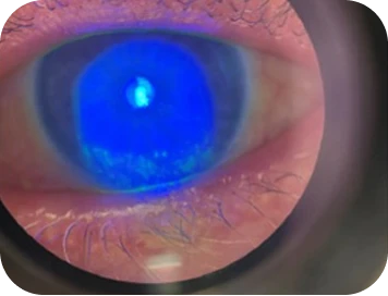 A dry eye patient with the history of autoimmune disease slit-lamp examination
