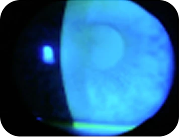 Dry eye in a contact lens wearer patient clinical findings.