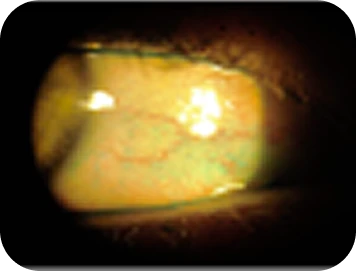 Dry eye in a contact lens slit-lamp examination.