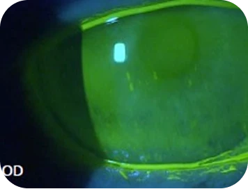 A symptomatic dry eye patient with inflammation clinical findings.
