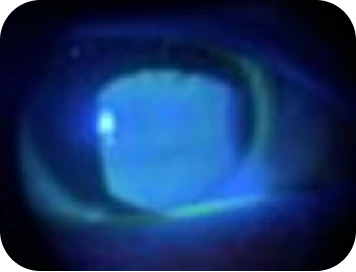 Dry eye patient with inflammation clinical findings.