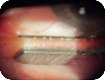 Dry eye patient with inflammation slit-lamp examination.