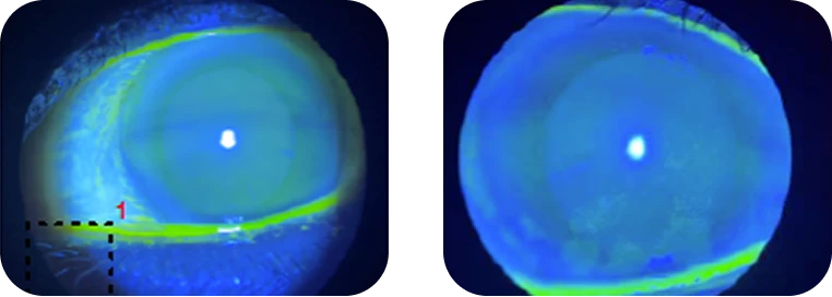 Dry eye patient with inflammation undergoing cataract surgery clinical findings.